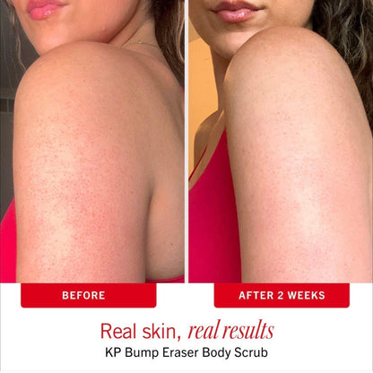 First Aid Beauty | KP Bump Eraser Body Scrub