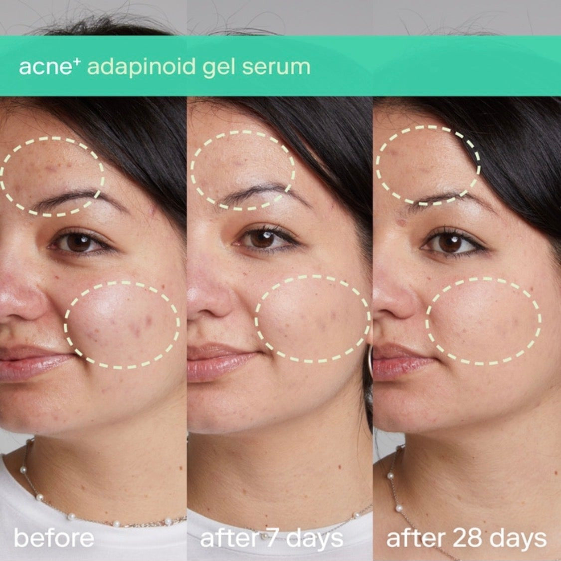 SKINFIX | Acne + Tripple Threat Set | Salicylic Acid + Niacinamide