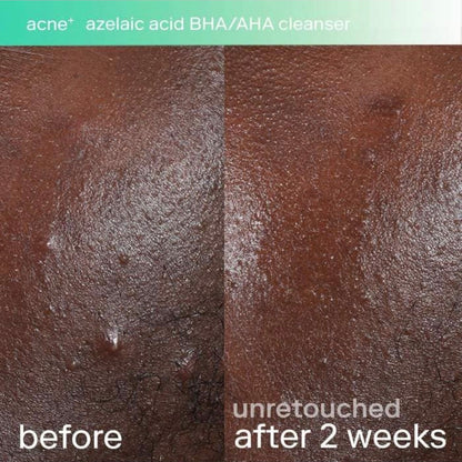SKINFIX | Acne + Tripple Threat Set | Salicylic Acid + Niacinamide