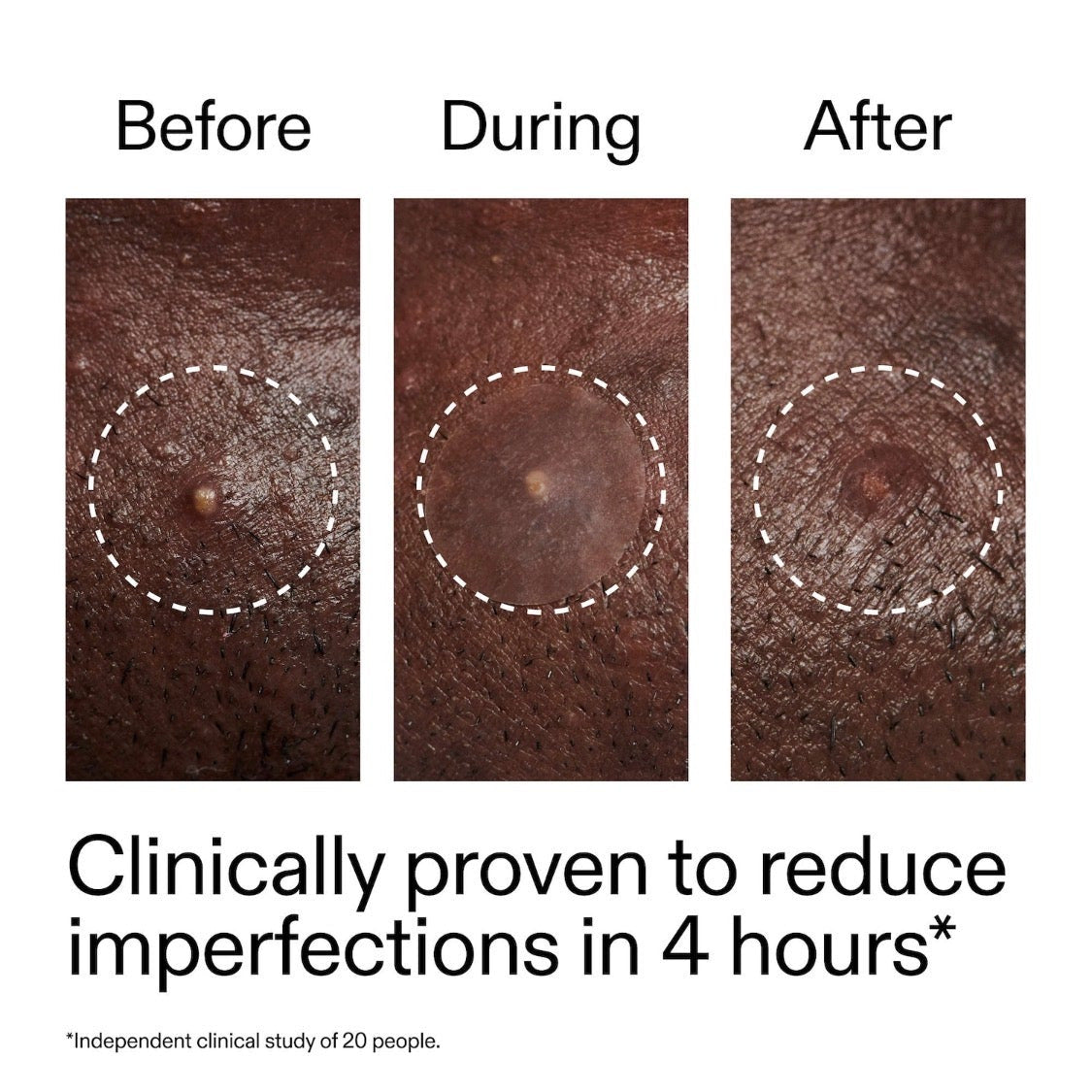 THE INKEY LIST | Hydrocolloid Invisible Patches