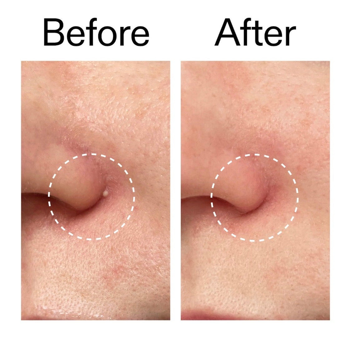THE INKEY LIST | Hydrocolloid Invisible Patches